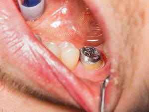 prótese dentária